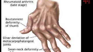 Rheumatoid Arthritis pathophysiology and pharmacology [upl. by Denney]