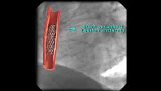 Kardiologie Wiederherstellung des Blutflusses bei Myokardinfarkt [upl. by Niuqauj189]