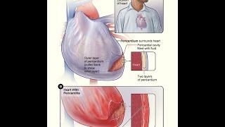 Pericarditis Definition Causes Clinical features Treatment and Prognosis [upl. by Melar840]