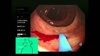 APC of colonic angiodysplasia [upl. by Natanhoj994]