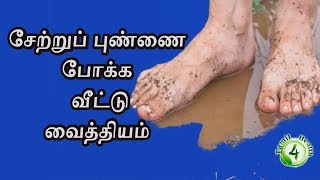 சேற்றுப் புண் குணமாக வீட்டுவைத்தியம் SETRU PUN [upl. by Infield258]