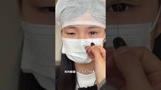 Beautiful double eyelids trending fyp rhinoplasty facelift PlasticSurgeon [upl. by Nonnag]