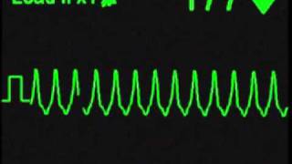 Monomorphic Ventricular Tachycardia  ECG Simulator  Arrhythmia Simulator [upl. by Kcirrek]