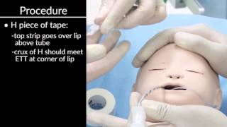 quotSecuring Oral and Nasal Endotracheal Tubesquot by Craig Smallwood RRT for OPENPediatrics [upl. by Adikram]