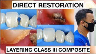 Step by step Layering Composite Class III Anterior  General Dentist Griya RR [upl. by Channa]