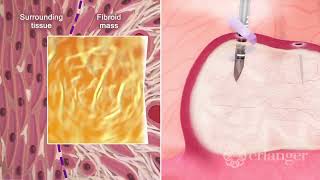 Minimally Invasive Fibroid Ablation – Dr Mitch Dizon [upl. by Nednyl276]