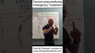 Tension pneumothorax emergency treatment shortvideo shorts drnajeeb drnajeeblectures [upl. by De]