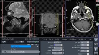 TMJ  Temporomandibular Eklem  MR Nasıl Çekilir Dinamik Sekans Nasıl AlınırMR Çekim Teknikleri [upl. by Bowen]