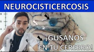 GUSANOS EN TU CEREBRO Neurocisticercosis Qué es Síntomas Diagnóstico Tratamiento Claro [upl. by Imeon]