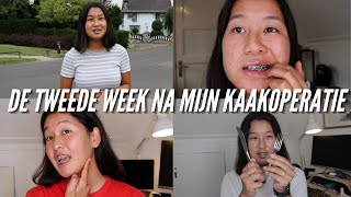 Tweede Week na Mijn Kaakoperatie 10 Weken Update Deel 22 [upl. by Akerboom616]