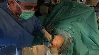 Operatie ligament  ACL surgery live [upl. by Jacobo]