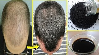 20 दिनों में कलोंजी से बालों को Regrowth करे  Kalonji For Hair Loss And Hair Regrowth [upl. by Vasyuta]