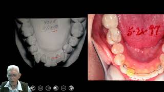 Palatal Separation on Older Patients [upl. by Ennairrac415]