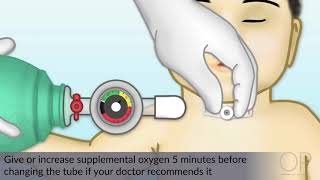 Changing a Tracheostomy Tube by J Nobrega M DeGrazia  OPENPediatrics [upl. by Ycul]