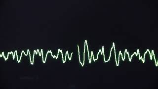 Ventricular fibrillation causes cardiac arrest [upl. by Aridaj]