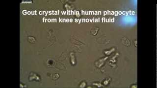 Live Synovial Gout phagocyte Showing Negative Birefringent Characteristic MSU Crystal [upl. by Mendel]