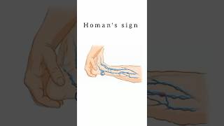 Homan’s Sign kattrucate medicalreels homan sign dvt thrombosis legs supine dorsiflexion [upl. by Rennane]