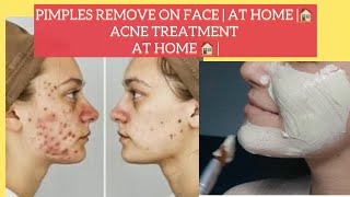 Pimples Remove on Face  at home 🏠 Acne Treatment at Home 🏠 [upl. by Ecyrb]