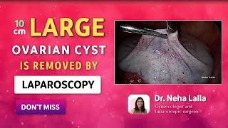 Laparoscopic ovarian cystectomy [upl. by Samanthia]