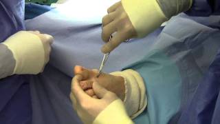 Dr Sherman Nagler  Bunionectomy  Akin Osteotomy [upl. by Zarla]