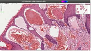 Angiokeratoma  Histopathology [upl. by Yttel]