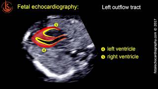 Fetal echocardiography at 1113 weeks Technique of Early Heart Scan [upl. by Lothair]