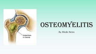 Ortho Osteomyelitis  acute hematogenous subacute hematogenous posttraumatic chronic OM [upl. by Zetram]