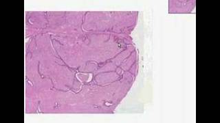 Histopathology BreastFibroadenoma [upl. by Armanda]