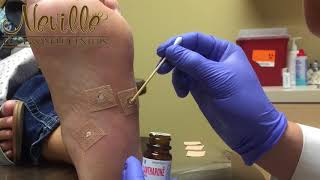 Removing a Wart on Feet PART 1 [upl. by Flam472]