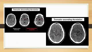 Brain herniation [upl. by Ahras784]