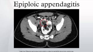 Epiploic appendagitis [upl. by Mareld]