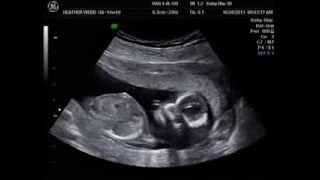 14 weeks 4 days Gender Reveal Ultrasound 2D 3D 4D [upl. by Giltzow]