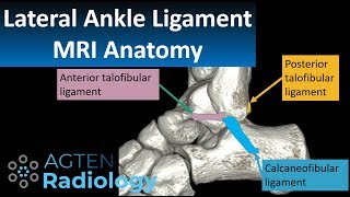 MRI Anatomy of lateral ankle ligaments [upl. by Winwaloe330]