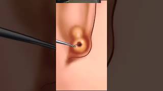 Ear Cleaning Asmr Satisfying Removel shorts [upl. by Aivan]