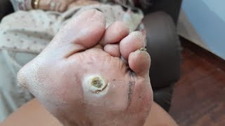 Warts Remove treatment part 2Treatment Continuefootcallous satisfying footcomfort footcare foot [upl. by Kruger]