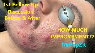 Severe Acne Follow up How did he do One round of extractions done [upl. by Senoj7]