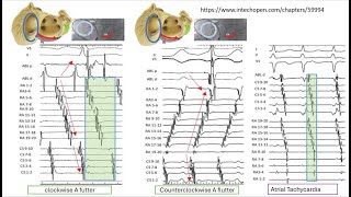 Introduction into intracardiac tracing \ slide show [upl. by Suoivatram]