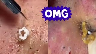 Top Acne Scar Treatments Proven Methods to Clear Your Skin Fast [upl. by Urial]