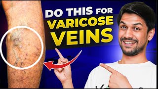 VARICOSE VEINS explained under 10 minutes  Saurabh Bothra Yoga [upl. by Reiter]