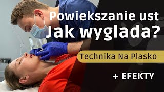 Powiększanie ust jak wygląda zabieg [upl. by Yaron161]