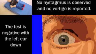 Animated Rotary Nystagmus During a Claymation DixHallpike Test for BPPV [upl. by Shem]