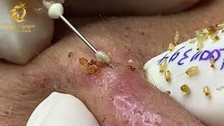 Treatment of blackheads and whiteheads 394  Loan Nguyen [upl. by Otilopih]