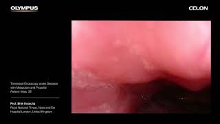 Drug Induced Sleep Endoscopy with CELON  Prof Bhik Kotecha  Part 3 [upl. by Huberto564]