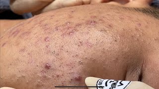 Blackheads amp Pimples Pore Removal New 2024  Acne Treatment With Bo Nguyễn Spa [upl. by Ollopa]