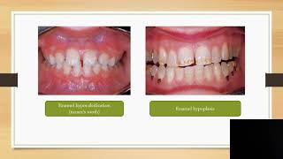 developmental alterations of the teeth  lec3 [upl. by Rakel]