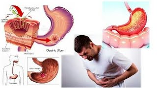 What is a gastritis causes of gastritis gestritis Animation 3d video gastritis  cardiac tech [upl. by Anahtor]