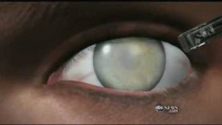 Medical Breakthrough Restoring Sight to the Blind [upl. by Noelani]