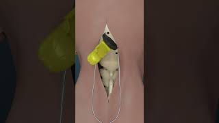 How Brain Clot Is Removed 3D Animation shorts [upl. by Orihakat496]