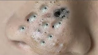 Big Cystic Acne Blackheads Extraction Blackheads amp Milia Whiteheads Removal Pimple Popping  3930 [upl. by Mellar]