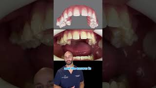 Can Invisalign Fix My Bite and Straighten My Teeth 2023 [upl. by Emsoc492]